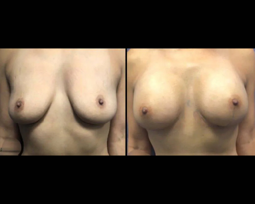 Breast Augmentation Patient Photos NYC