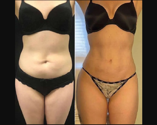 Before and After Liposuction patient Photo - Front View