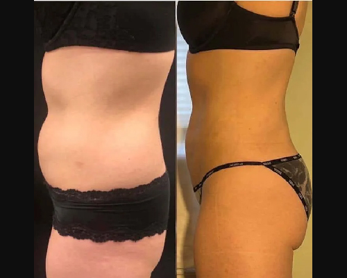 Best Liposuction Before and After Photos NYC