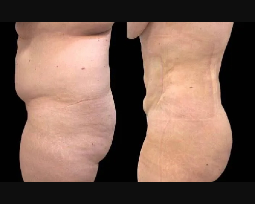 liposuction03-01