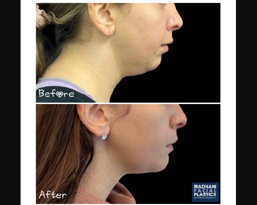 Chin Implant Before and After Side Photo