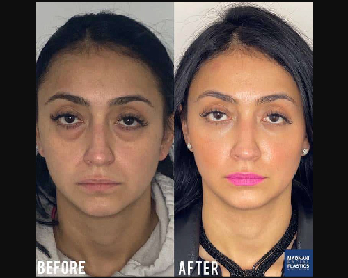 Before and After Facial Fat transfer Patient NYC