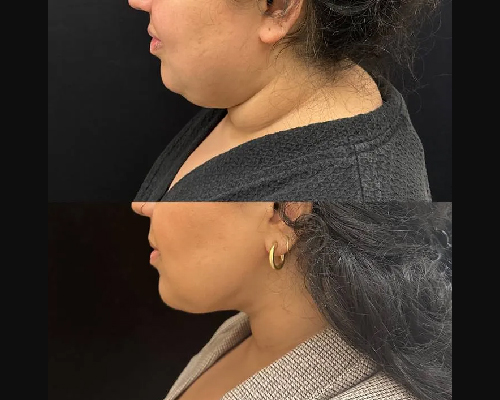double chin surgery patient before and after photo side profile