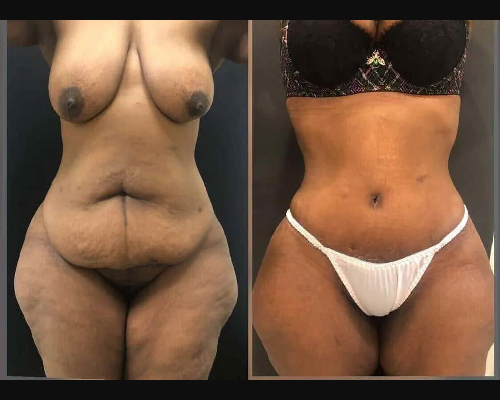 Before and After Tummy Tuck Patient Photos