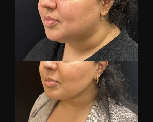 double chin surgery patient before and after photo