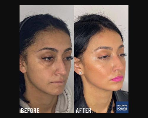 Facial Fat Transfer Before and After Side View