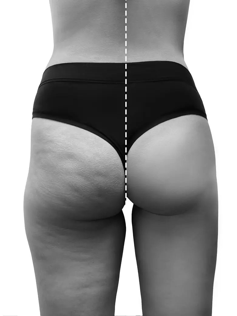 Amazing Before and After Thigh Lift Results