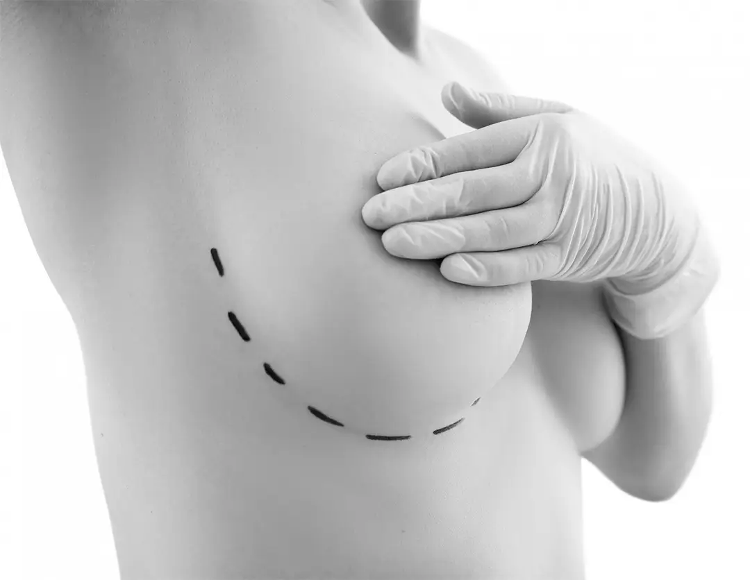 best Breast Revision Surgery NYC